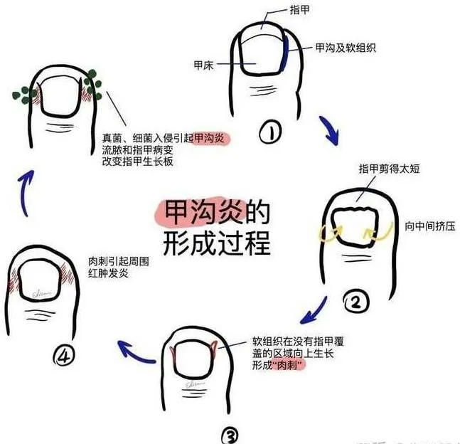 手指甲沟炎办法图片