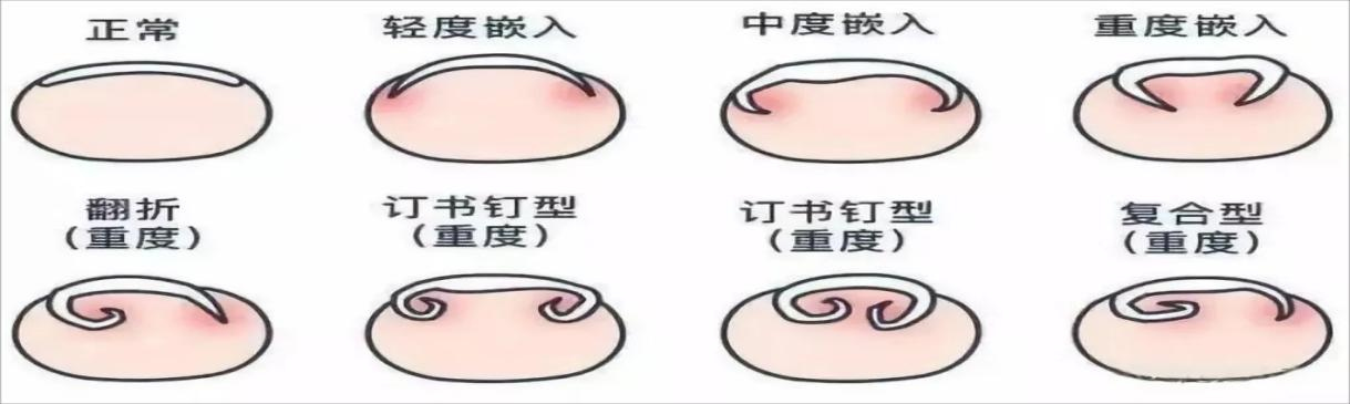 手指甲沟炎办法图片